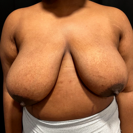 Before image 1 Case #127516 - Breast Reduction