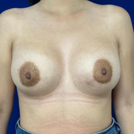 After image 1 Case #127126 - Clinical Case 2 – Breast Augmentation Surgery