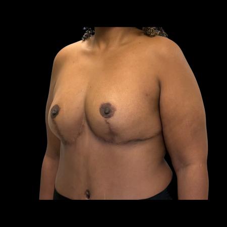 After image 4 Case #126946 - Mastopexy without Implants 