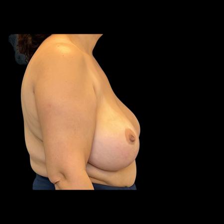Before image 3 Case #126951 - Revision mastopexy