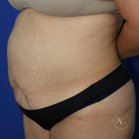 Before image 2 Case #127456 - Circumferential trunk lipo and abdominoplasty