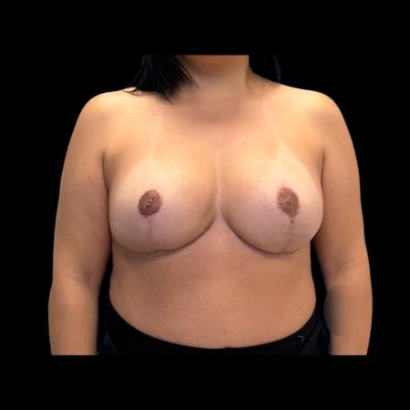 After image 1 Case #126941 - Breast Reduction