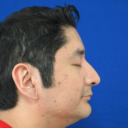 Before image 3 Case #127141 - Case 6 - Rhinoplasty