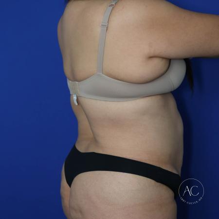Before image 4 Case #127456 - Circumferential trunk lipo and abdominoplasty