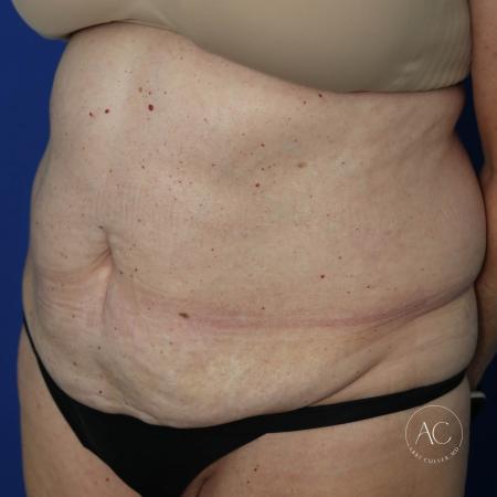 Before image 2 Case #127481 - Circumferential trunk lipo and abdominoplasty