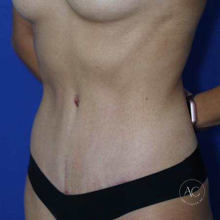After image 2 Case #127436 - Abdominoplasty