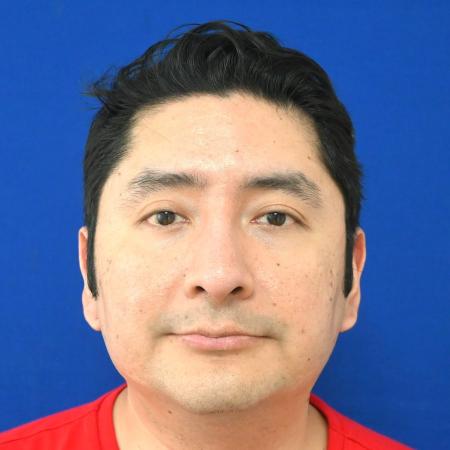 Before image 1 Case #127141 - Case 6 - Rhinoplasty