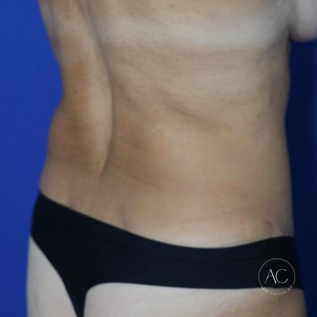 After image 4 Case #127496 - Abdominoplasty