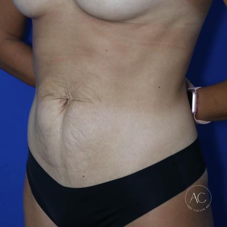 Before image 2 Case #127436 - Abdominoplasty