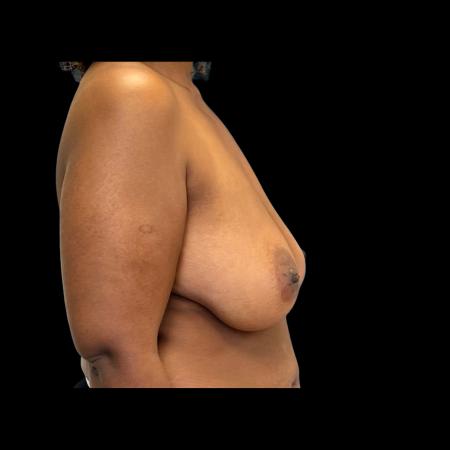 Before image 3 Case #126946 - Mastopexy without Implants 
