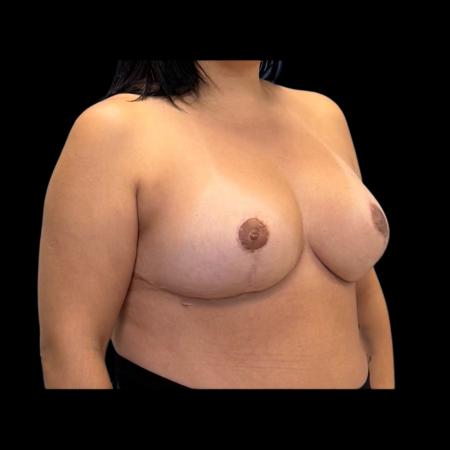 After image 2 Case #126941 - Breast Reduction