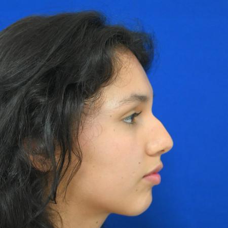 Before image 3 Case #127121 - Case 1 - Rhinoplasty 