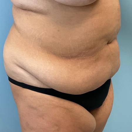 Before image 2 Case #127386 - 35 y.o. female w/ Tummy Tuck & Lipo of flanks 
