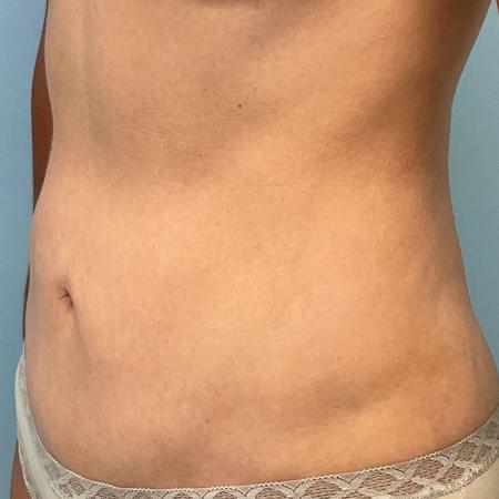 After image 2 Case #126926 - a 47 year old female; mini tummy tuck w/ lipo 360 