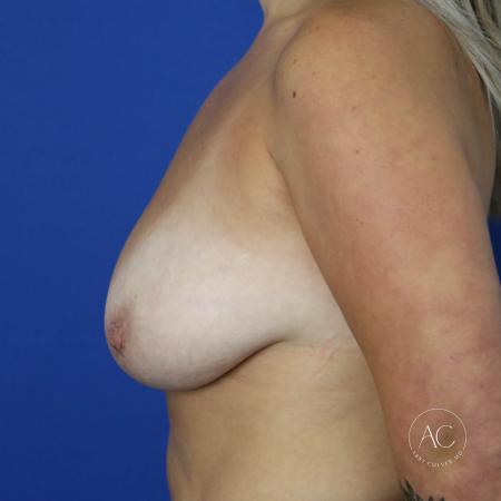 Before image 3 Case #127441 - Breast lift with implants
