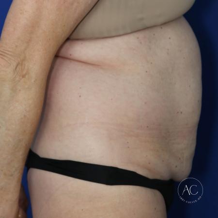 Before image 3 Case #127481 - Circumferential trunk lipo and abdominoplasty