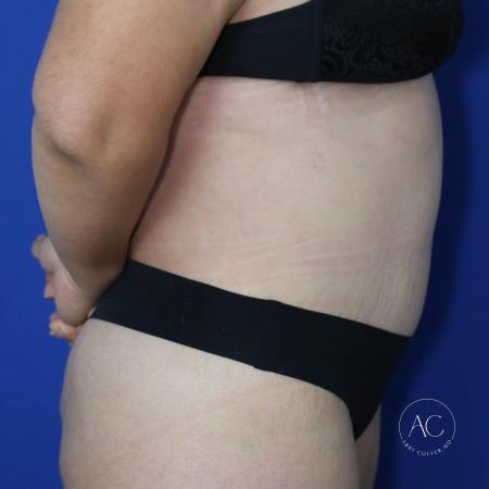 After image 3 Case #127456 - Circumferential trunk lipo and abdominoplasty