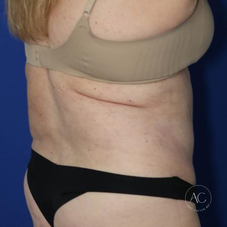 After image 4 Case #127481 - Circumferential trunk lipo and abdominoplasty
