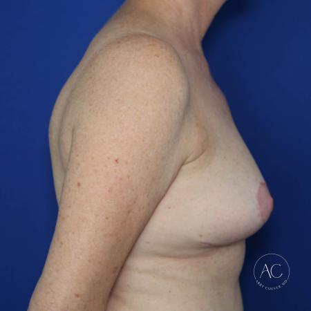 After image 3 Case #127946 - Breast reduction and scar revision