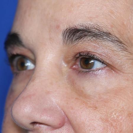 Before image 2 Case #127906 - Upper blepharoplasty