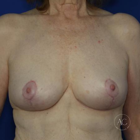 After image 1 Case #127896 - Breast lift 