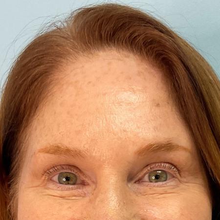 After image 2 Case #127936 - 56 y.o. female with Botox 