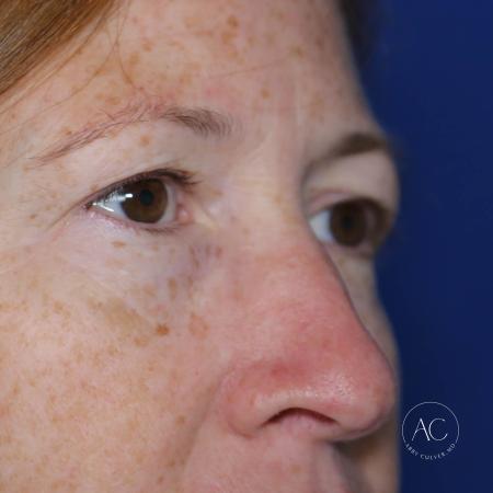 Before image 3 Case #127901 - Upper blepharoplasty
