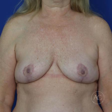 After image 1 Case #128206 - Breast implant removal and lift