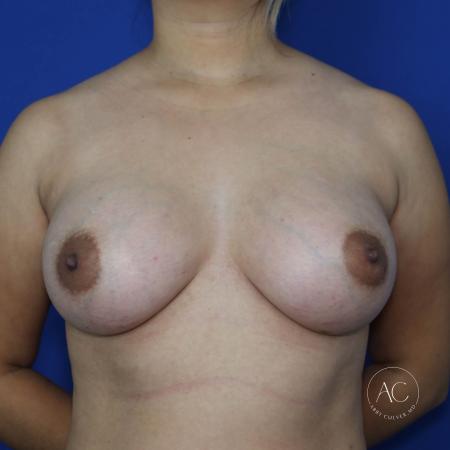 After image 1 Case #128211 - Breast augmentation