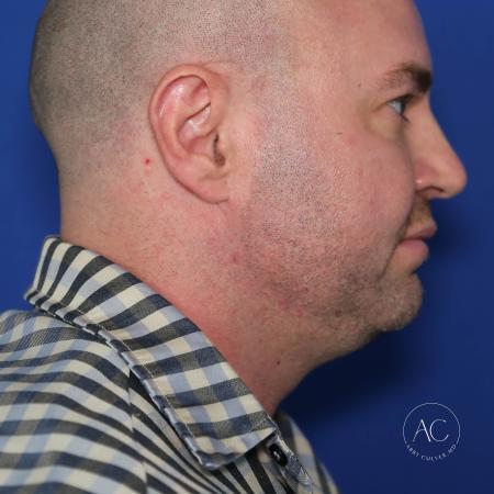 Before image 3 Case #128221 - Upper bleph, buccal fat reduction, submental lipo