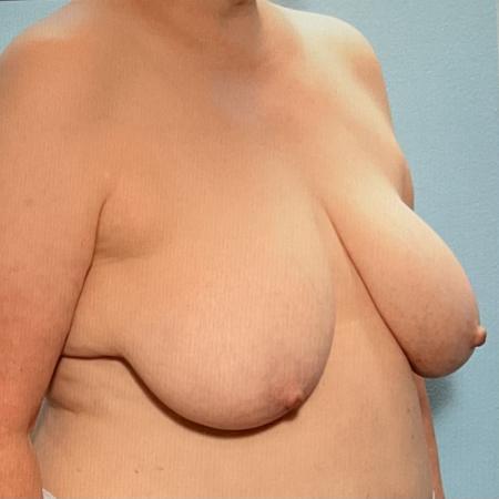 Before image 2 Case #128286 - Breast Lifting 