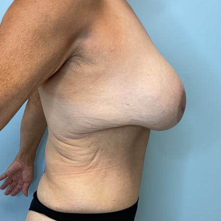 After image 3 Case #127966 - 60 y.o. female' Tummy Tuck & Breast Aug w/ lift