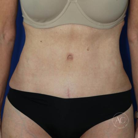 After image 1 Case #128061 - Abdominoplasty