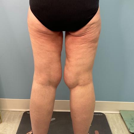 Before image 4 Case #128241 - 66 y.o. female w/ Thigh Lift & Lipo Thighs & Calf