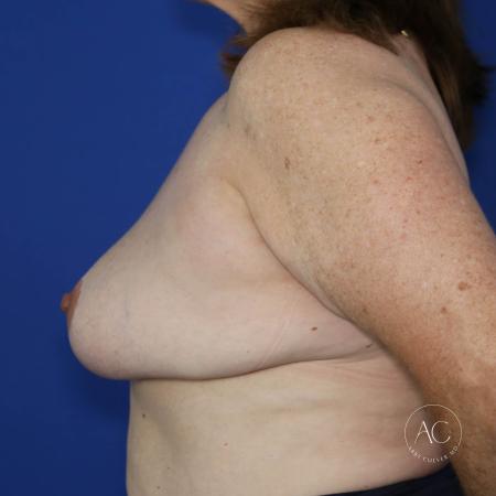 Before image 3 Case #128066 - Lateral chest lift