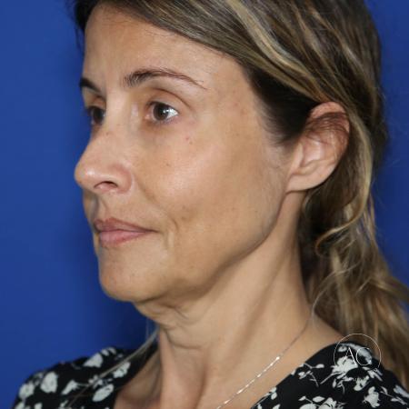 Before image 2 Case #128201 - Deep plane facelift, necklift, upper/lower bleph