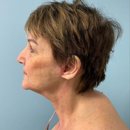 After image 3 Case #127961 - 69 y.o. w/ Face & Neck Lift, MyEllevate & Renuvion