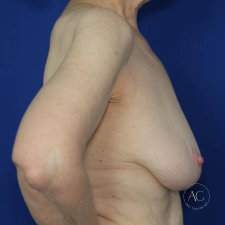 Before image 3 Case #127896 - Breast lift 