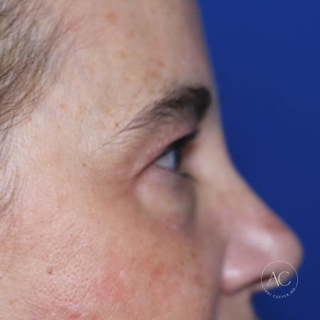 Before image 3 Case #127906 - Upper blepharoplasty