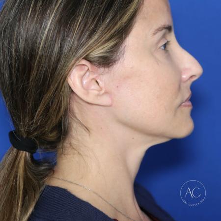 After image 3 Case #128201 - Deep plane facelift, necklift, upper/lower bleph