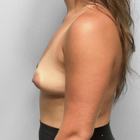 Before image 3 Case #127636 - Breast Augmentation