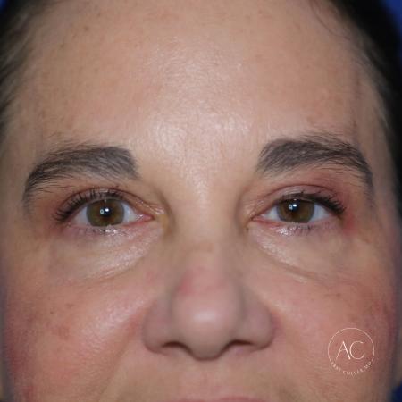 After image 1 Case #127906 - Upper blepharoplasty