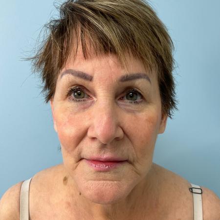 After image 1 Case #127961 - 69 y.o. w/ Face & Neck Lift, MyEllevate & Renuvion