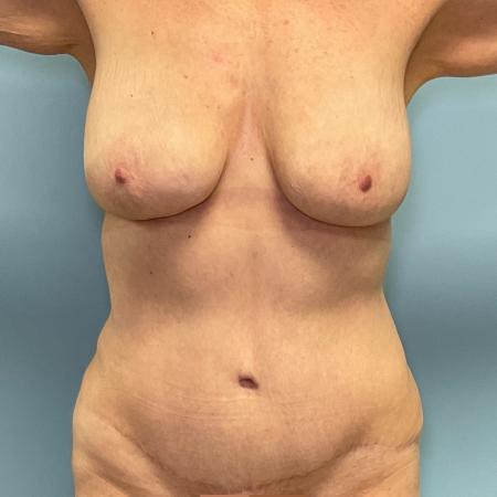 After image 1 Case #127561 - Tummy Tuck + Lipo of Flanks + Fat Graft to Breasts