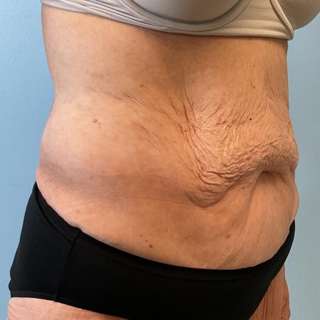 Before image 2 Case #127556 - Tummy Tuck + Lipo of Flanks/Thighs + Bra Line Lift