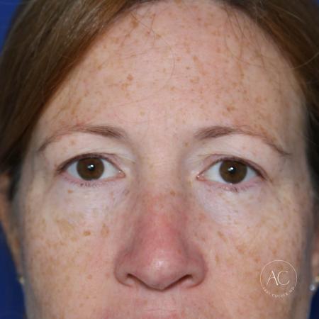 Before image 1 Case #127901 - Upper blepharoplasty