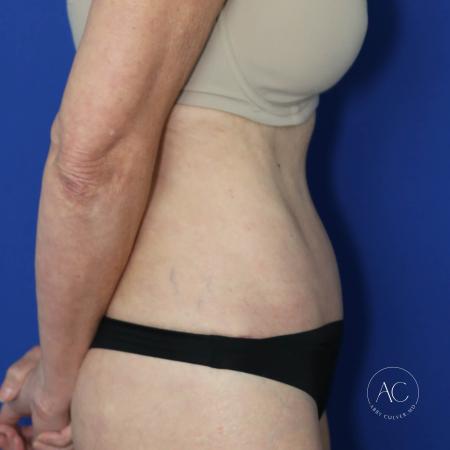 After image 3 Case #128061 - Abdominoplasty