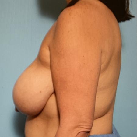 Before image 3 Case #128256 - Breast Lifting