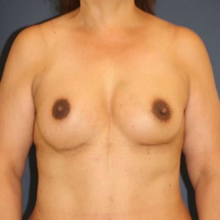 After image 3 Case #127621 - Breast Augmentation