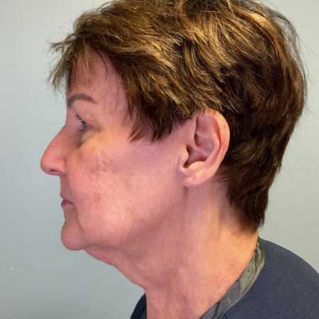 Before image 3 Case #127961 - 69 y.o. w/ Face & Neck Lift, MyEllevate & Renuvion